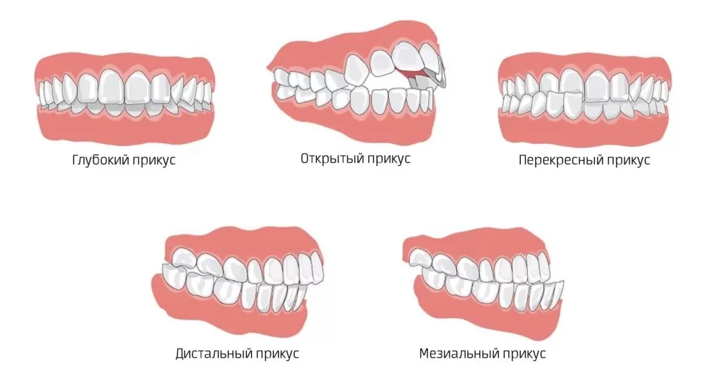 Неправильный прикус - одна из причин избыточного патологического стирания зубной эмали